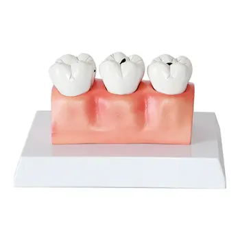 Carii dentare modelul de copii cariilor dentare model de sănătate orală patologice cariilor dentare anatomice model